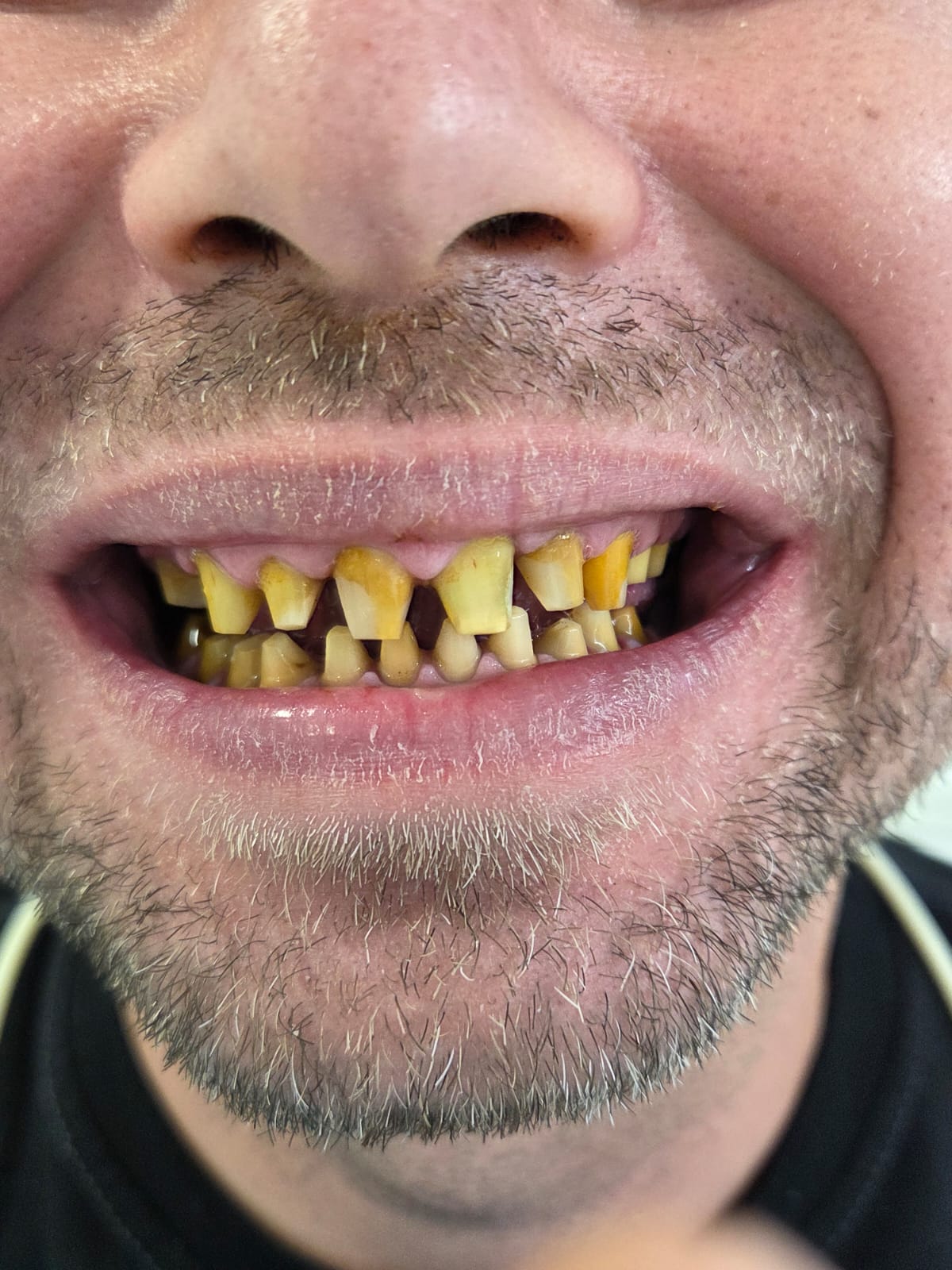 Porcelain Veneers — Complete smile transformation