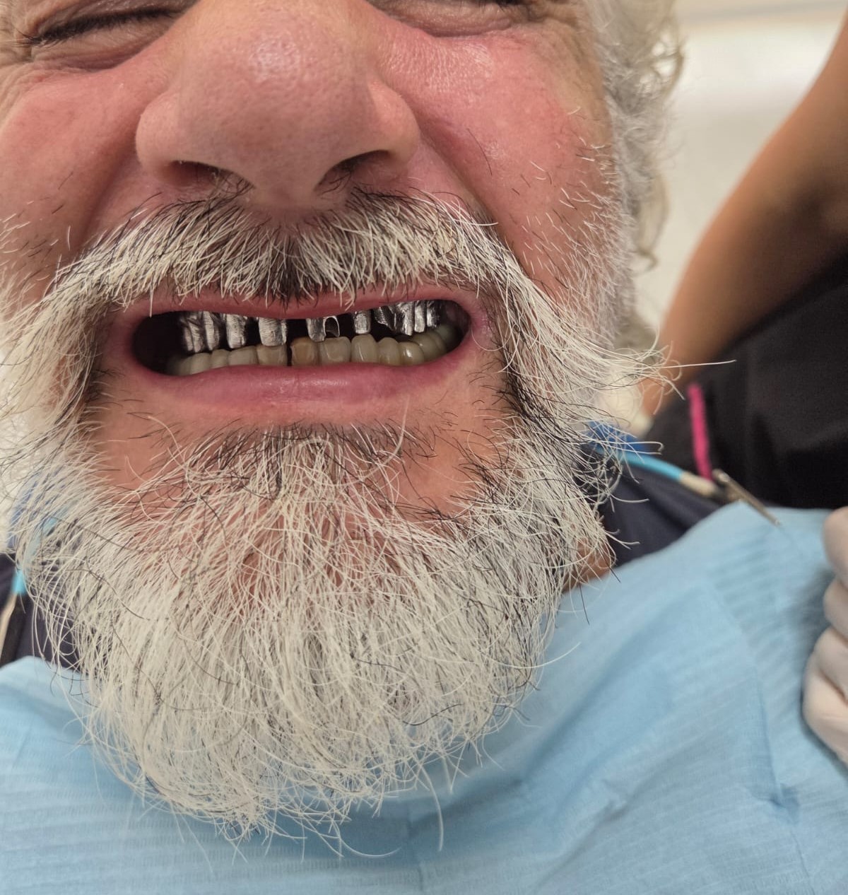 Zirconia Crowns & Veneers — Full mouth restoration