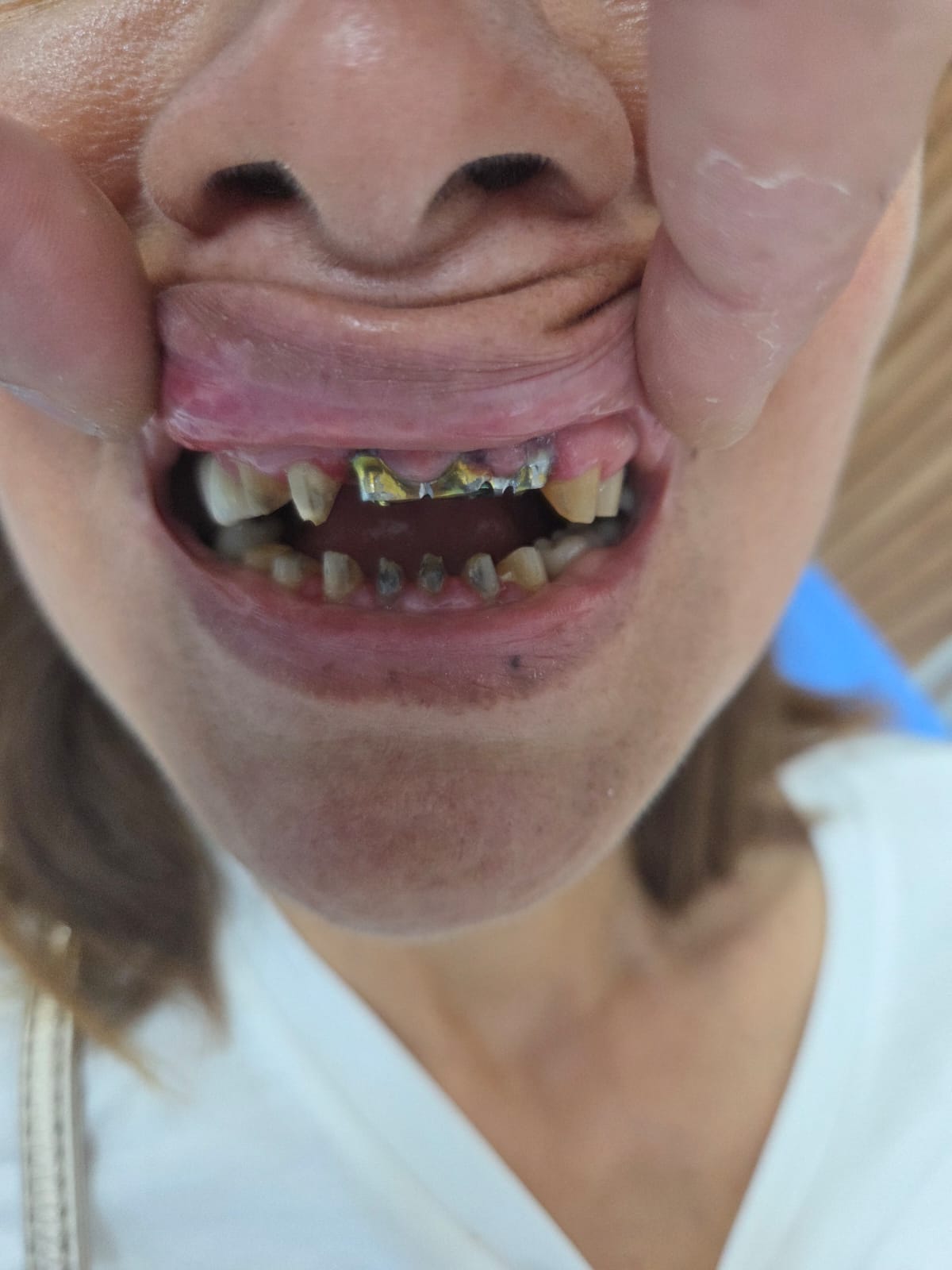 Dental Implants — Full mouth rehabilitation