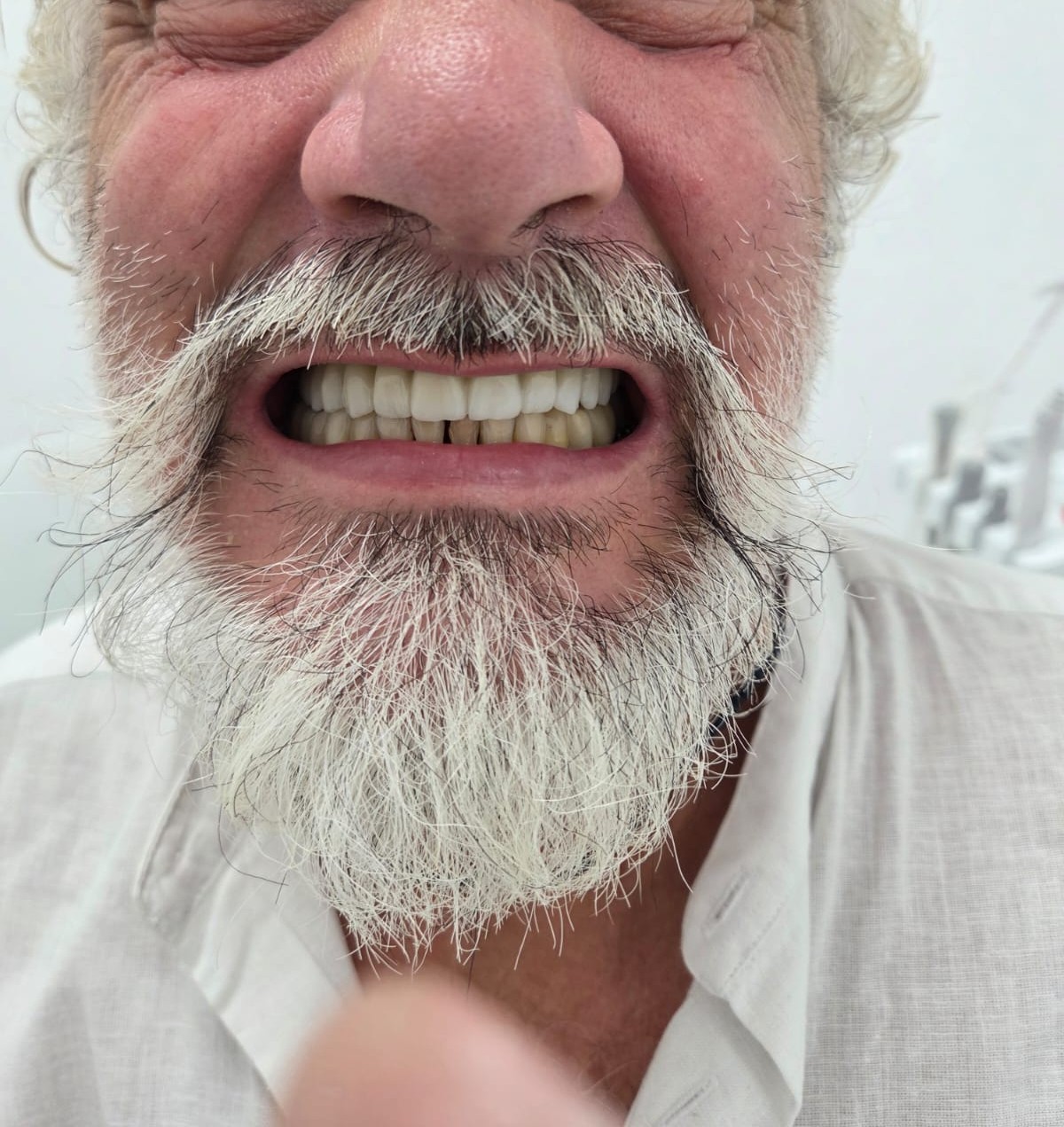 Zirconia Crowns & Veneers — Full mouth restoration