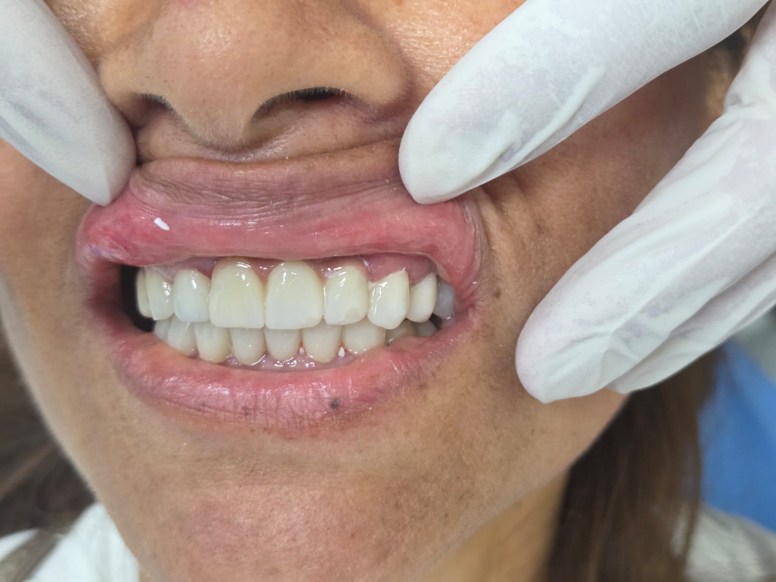 Dental Implants — Full mouth rehabilitation