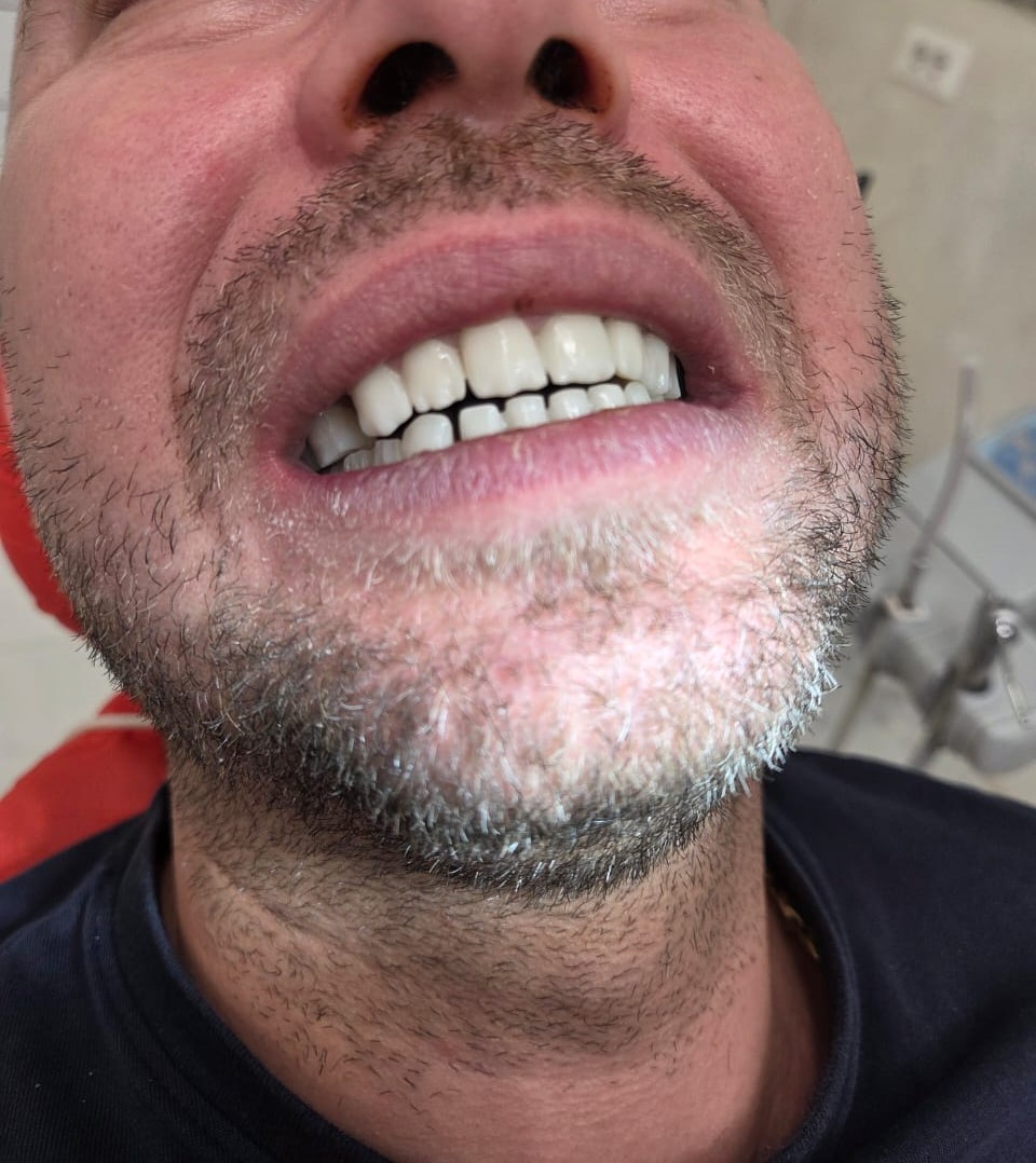 Porcelain Veneers — Complete smile transformation